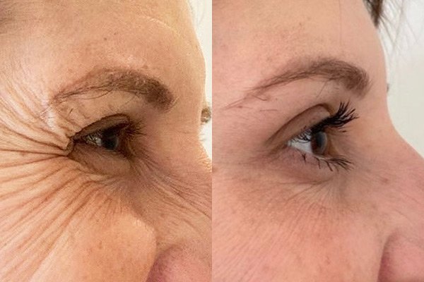 harmonização antes e depois