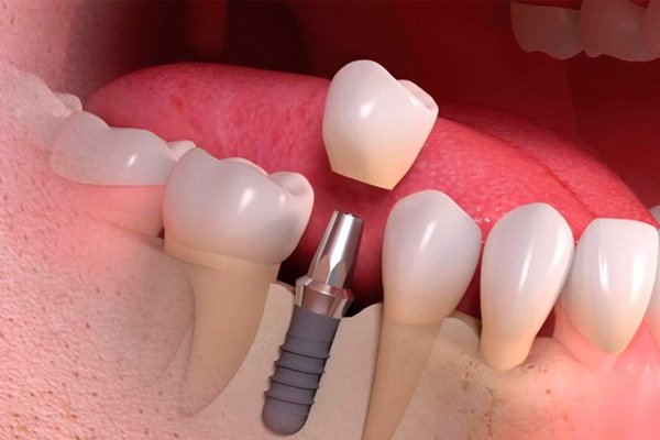 implantes dentários